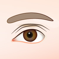 雙眼皮手術常見併發症1