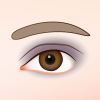 雙眼皮手術常見併發症4