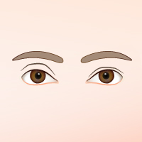 雙眼皮手術常見併發症5