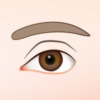 雙眼皮手術常見併發症6