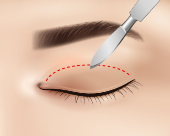 外開提眼肌手術步驟2