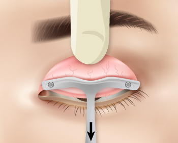 內開式提眼肌手術步驟1
