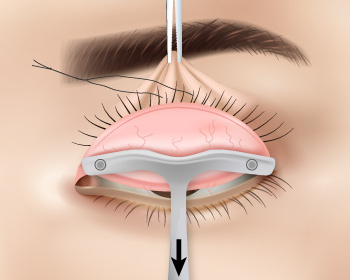 內開式提眼肌手術步驟2