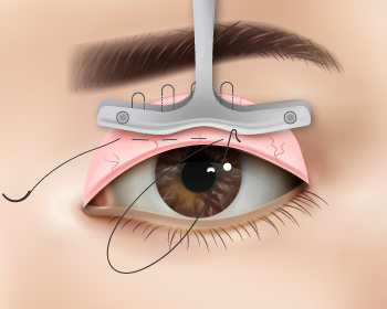 內開式提眼肌手術步驟3