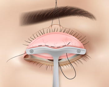 內開式提眼肌手術步驟4
