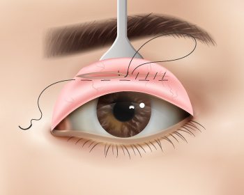 內開式提眼肌手術步驟6