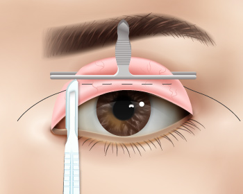 內開式提眼肌手術步驟5