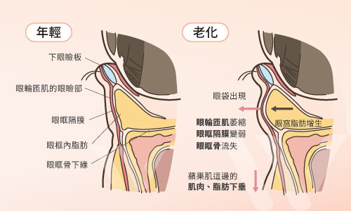 因為老化而形成眼袋