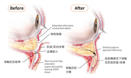 眼袋內開+脂肪轉位填補淚溝術前術後