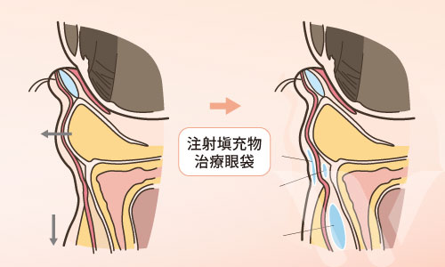 濰視美學採用眼袋內開/筋膜層修補/合併玻尿酸注射