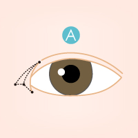 開眼頭手術流程1