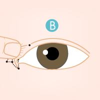 開眼頭手術流程2