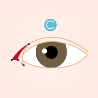 開眼頭手術流程3