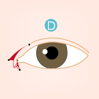 開眼頭手術流程4