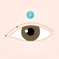 開眼頭手術流程6