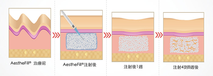 艾麗斯精靈針的兩種作用