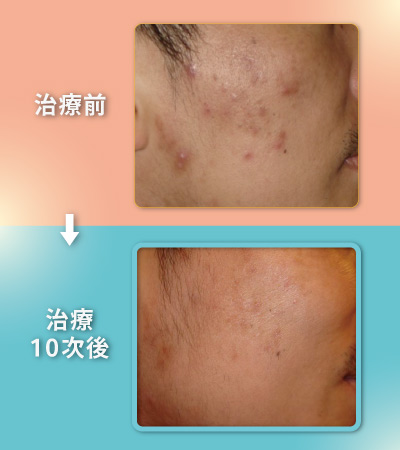 痤瘡、粉刺肌膚、毛孔粗大患者換膚療程術前術後