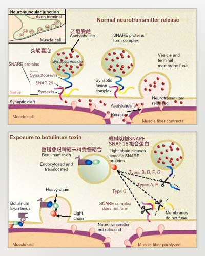 Dysport皇家肉毒桿菌的作用機轉